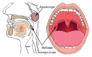 как отличить аденоиды от гланд