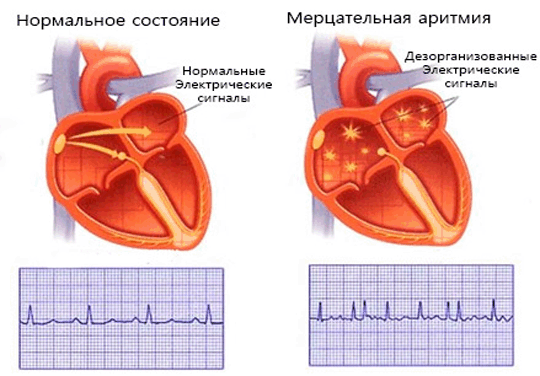 приступ мерцательной аритмии