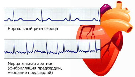 мерцательная аритмия на ЭКГ