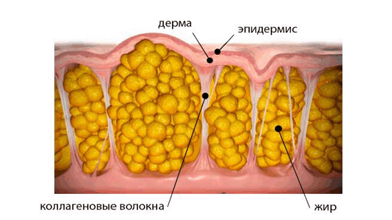 стадии развития целлюлита