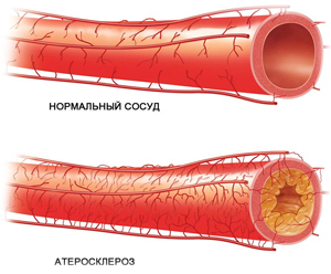 атеросклероз сосудов