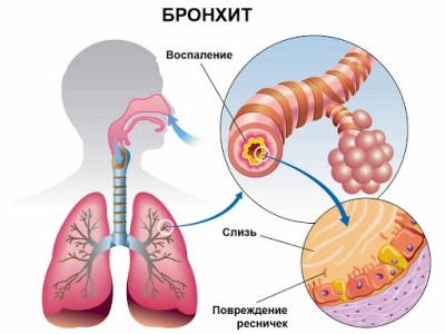 как вылечить бронхит