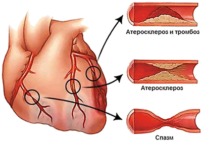 грипп при больном сердце