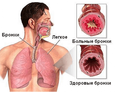 как вылечить хобл