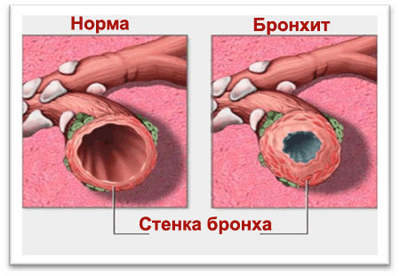 хронический бронхит