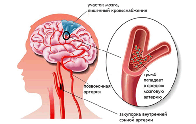 инсульт