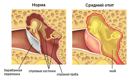 отит