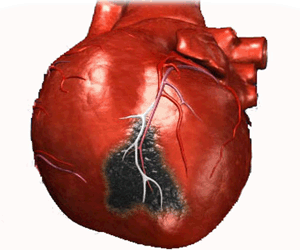 причины инфаркта миокарда
