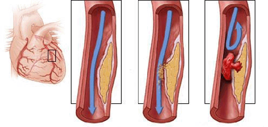 тромбоз коронарной артерии