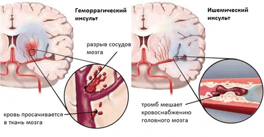 виды инсульта